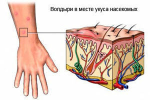 Волдыри на месте укуса являются аллергической реакцией организма 