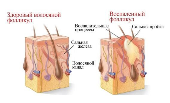 Формирование фурункулеза